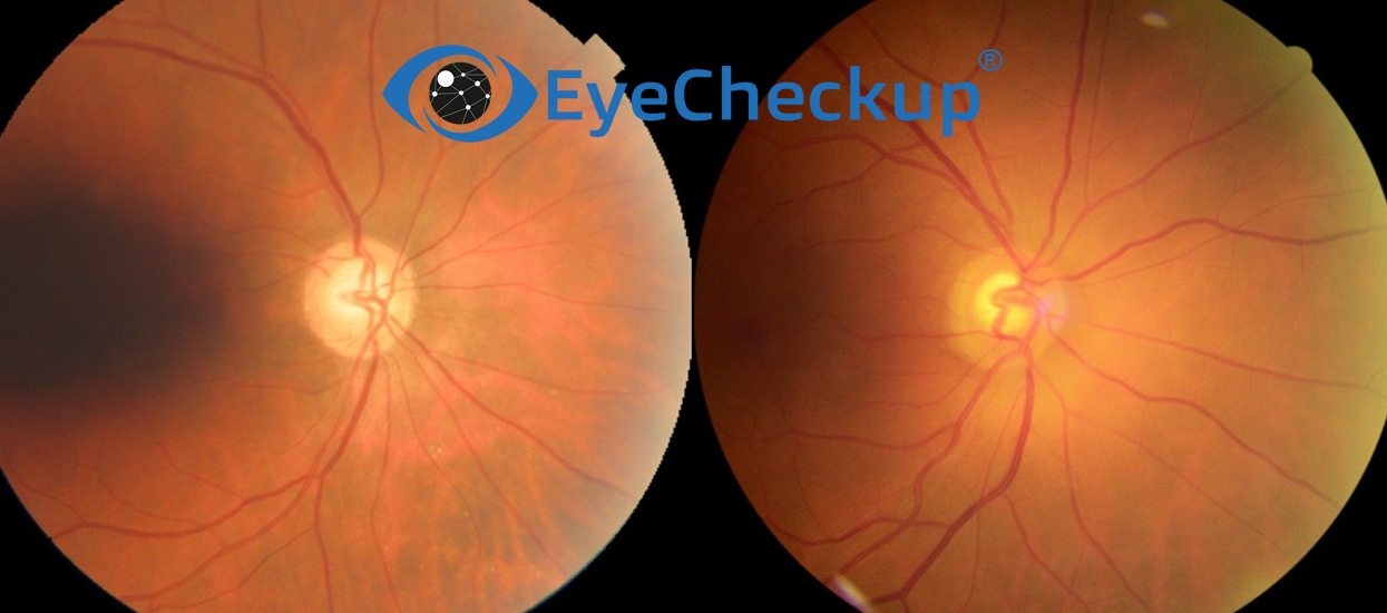 What is glaucoma